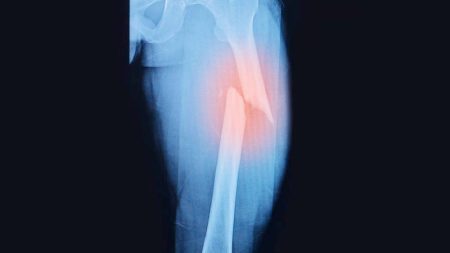تقنية مبتكرة لعلاج العظام المكسورة بسرعة