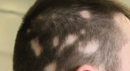 استشاري أمراض جلدية: الثعلبة سببها العامل النفسي