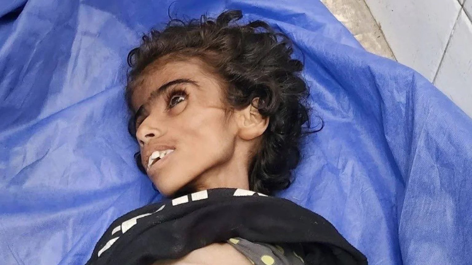 الإعلام الإسرائيلي يرصد حجم التناقض في التصريحات بشأن المجاعة بغزة