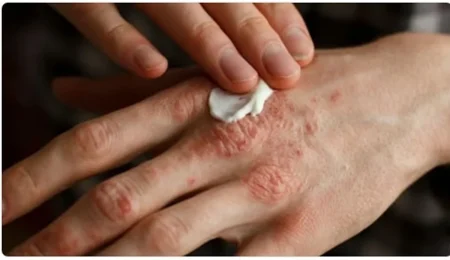 استشاري: الرجال أكثر عرضة للإصابة بمرض الصدفية وينتشر في العمر أقل من 30 عاما