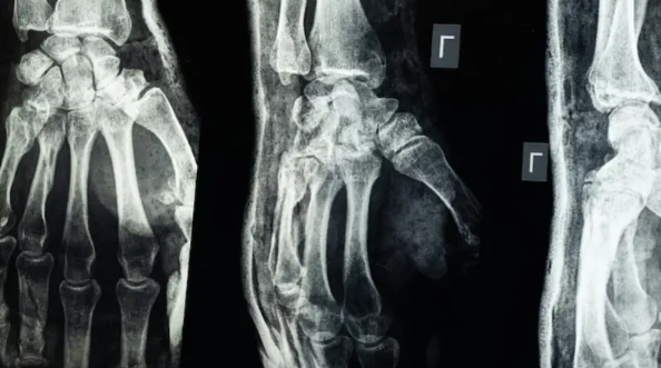 لا داعي لزراعة المسامير والصفائح .. “غراء طبي” يجبر العظام المكسورة في “3 دقائق” فقط