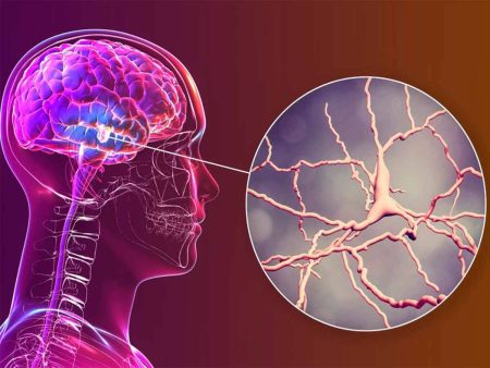 علماء أمريكيون يطوّرون غرسة دماغية تخفف الألم المزمن
