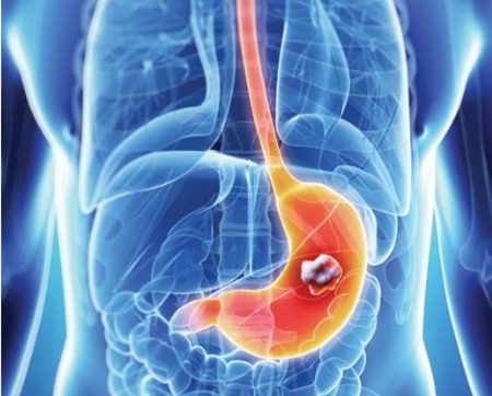 استشاري: 4 نصائح طبية للوقاية من سرطان المعدة