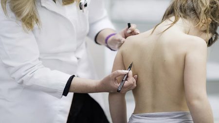 فهد الطبية توضّح علامات مرض الجنف وطرق علاجه