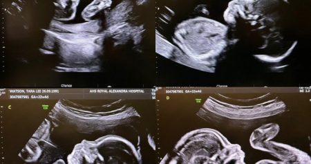 ULTRASOUND 4 APRIL e1715645555392