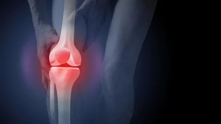 arthritis knee pain.webp