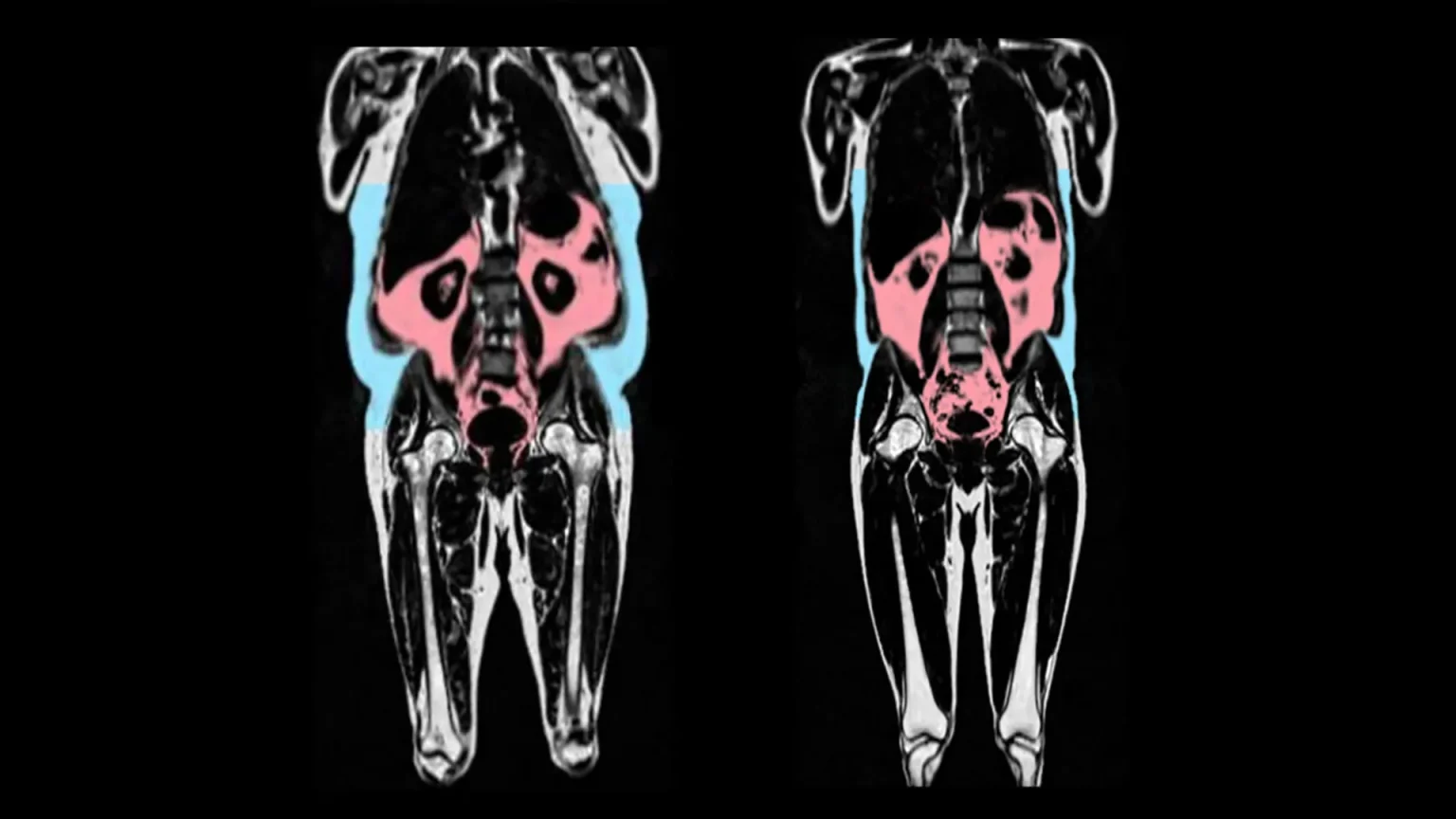 body fat on mri scan.webp