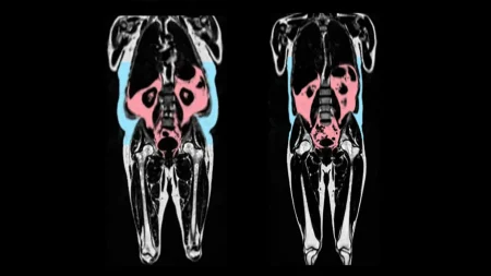 body fat on mri scan.webp