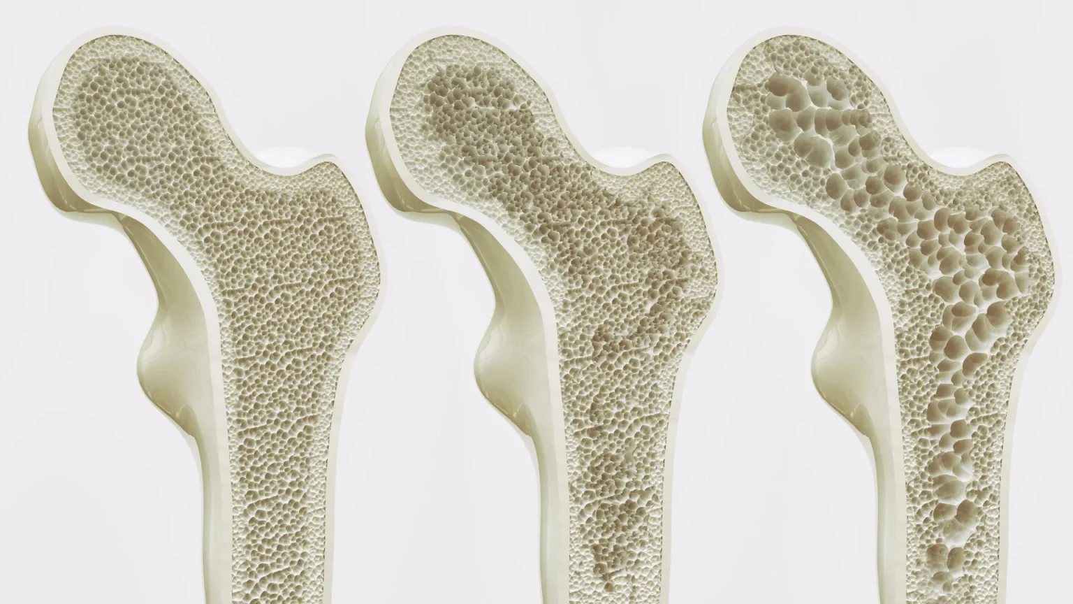 osteoporosis stages hip bone strength.webp