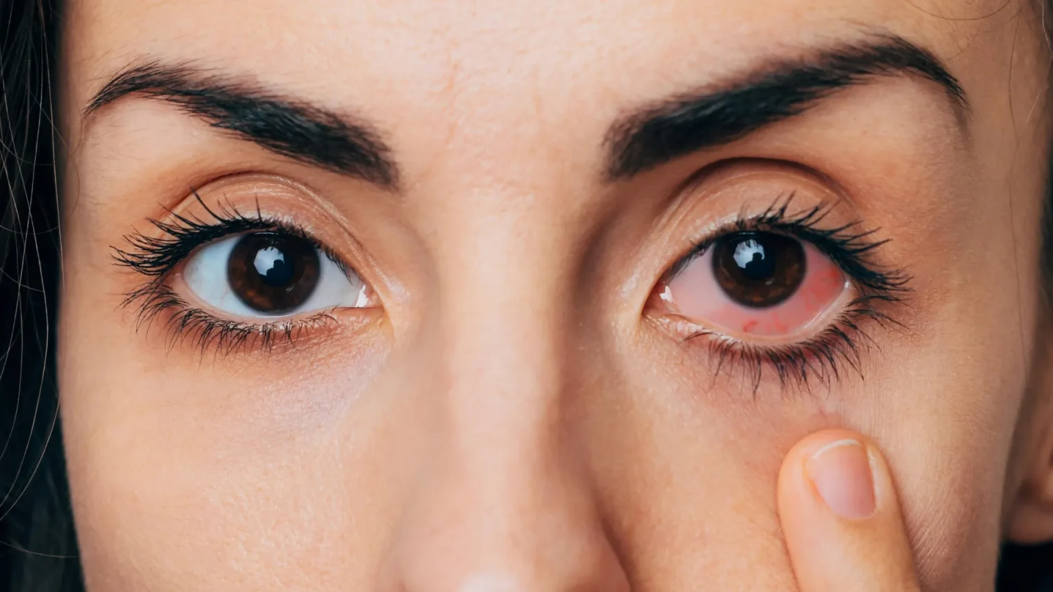 red eye close up before and after treatment.webp